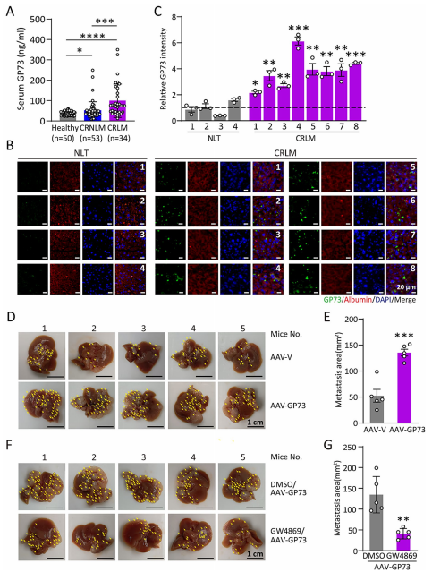 结直肠癌肝转移患者的肝脏GP73表达呈现病理性升高